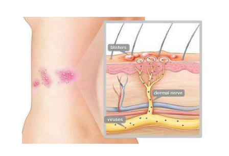 長水痘的症狀 (47) 