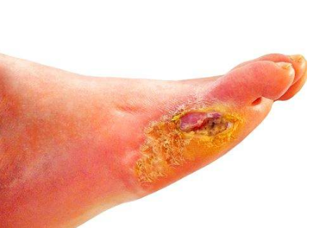 脈管炎早期症狀