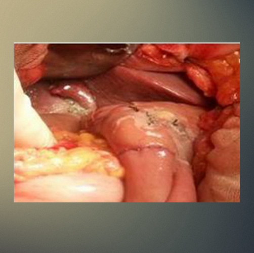 什麼是膽管癌黃疸