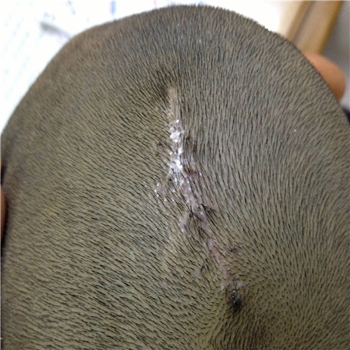 皮脂腺痣術後恢復