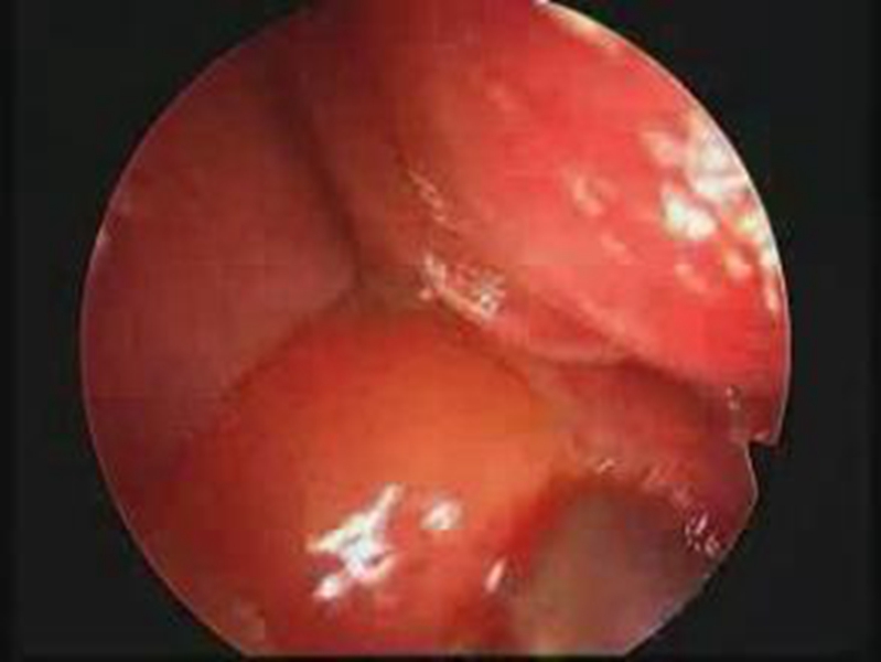 成人喉血管瘤檢查的
