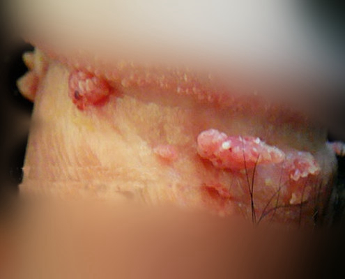 男性尖銳溼疣照片 (6) 