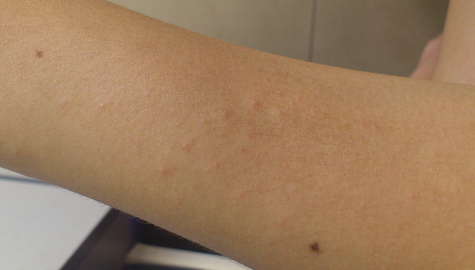 皮膚澱粉樣變 (54) 