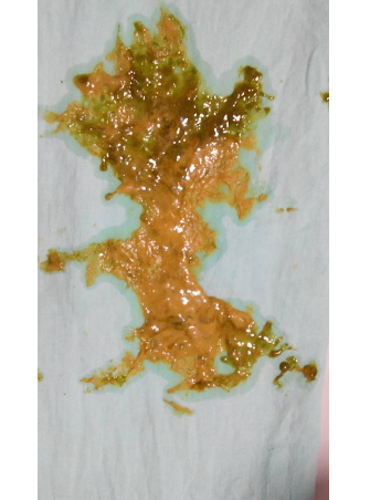 新生兒腹瀉大便