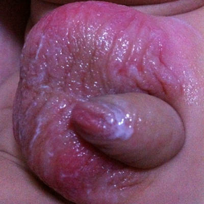 男寶寶疝氣的症狀