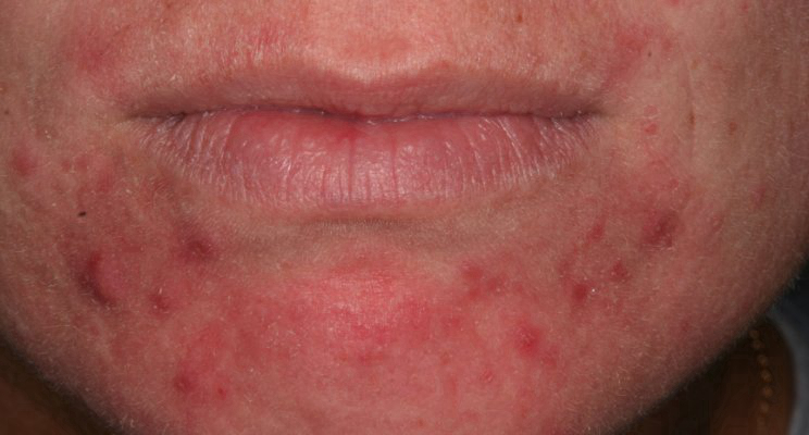 急性皮炎的症狀