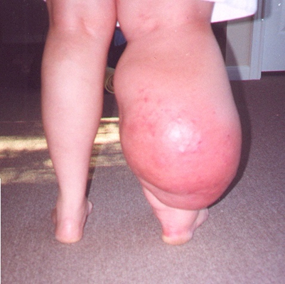 肢端肥大症  (43) 