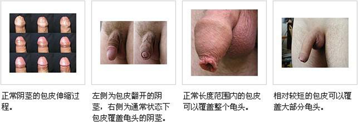 包皮過長