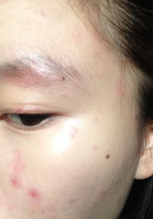 臉上皮膚過敏症狀