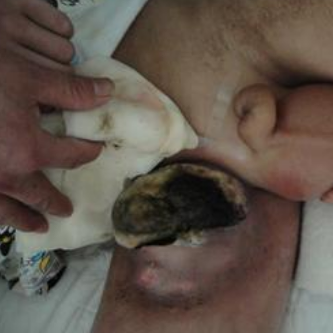 腿部的淋巴癌早期症狀的