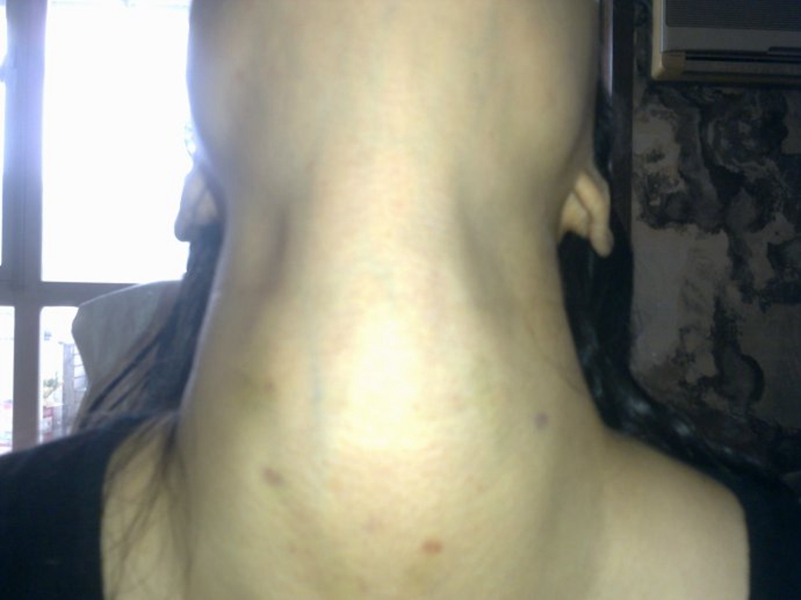 橋本甲狀腺炎嚴重腫大