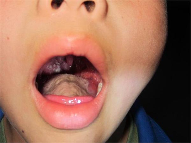 小孩的急性咽炎