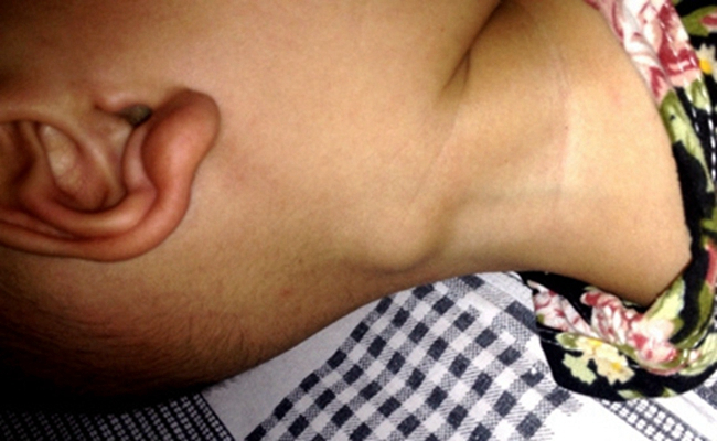 頜下淋巴結腫大