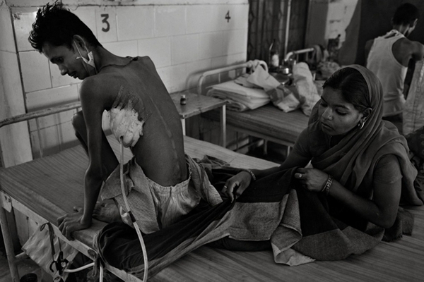 空洞型肺結核能活多久 (48) 