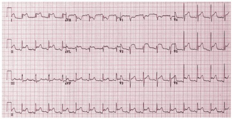 房顫心電圖特點 (62) 