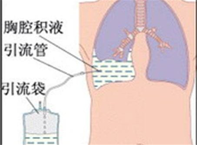 結核性胸膜炎引流