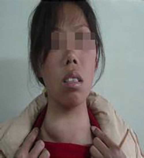 女性甲狀腺瘤的症狀