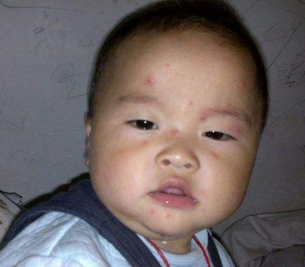 長水痘的症狀 (8) 