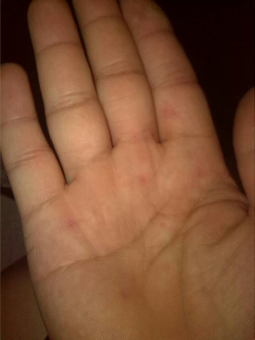 手部溼疹治療後的