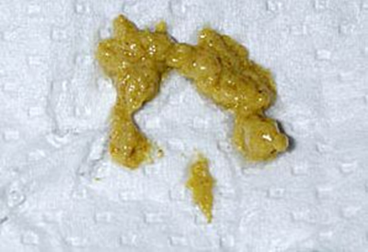 寶寶輕微母乳性腹瀉