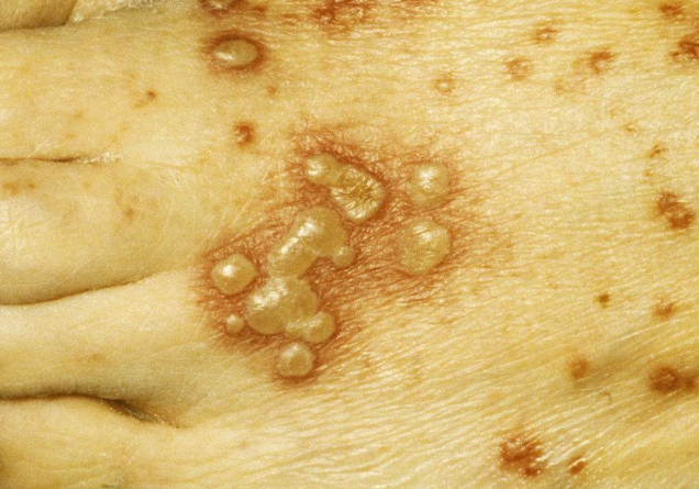 帶狀皰疹樣外觀