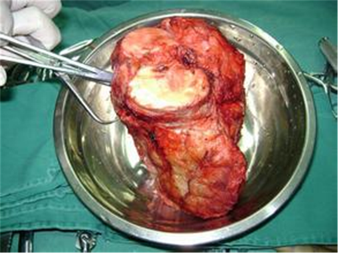 治療男惡性骨腫瘤