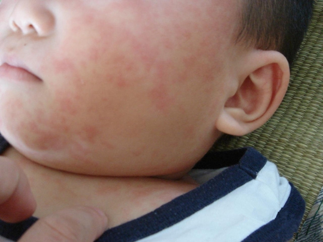 退燒後急疹已經7天的