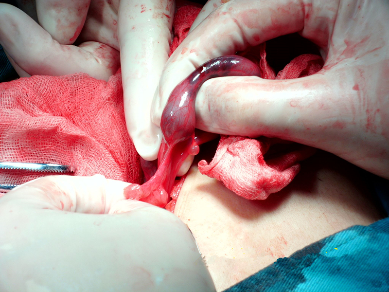 輸卵管宮外孕高清