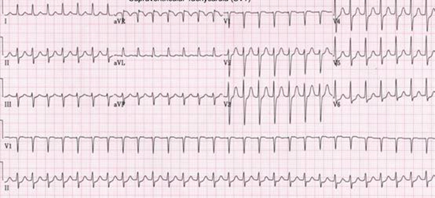 高鉀血癥心電圖 (46) 