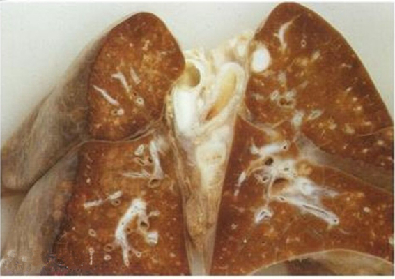 空洞型肺結核能活多久 (8) 