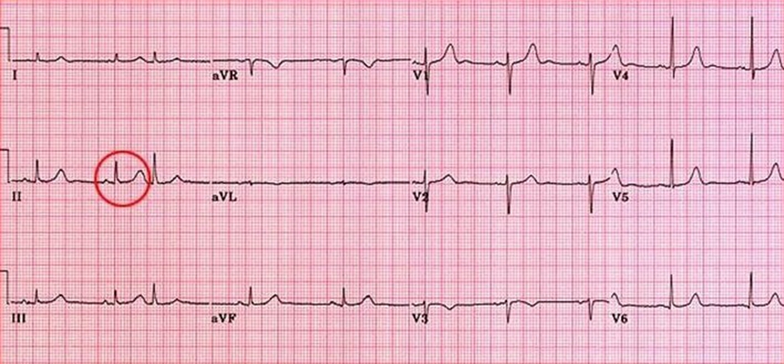頻發房性早搏 (43) 