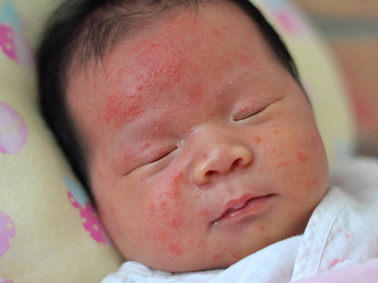 新生兒胎毒的症狀