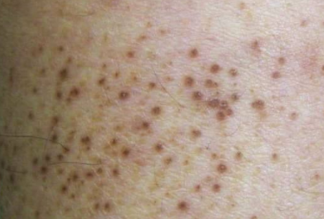 皮膚澱粉樣變 (61) 