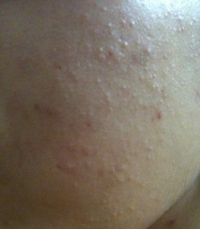 粟丘疹 (43) 