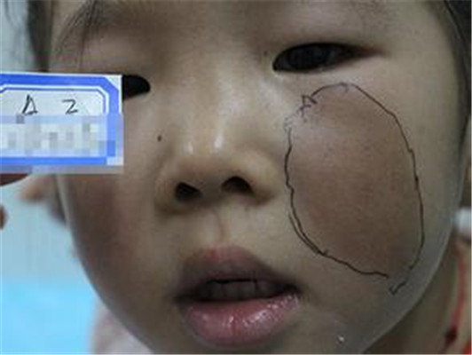 牛奶咖啡斑 (42) 