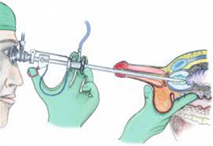 早期陰莖癌手術