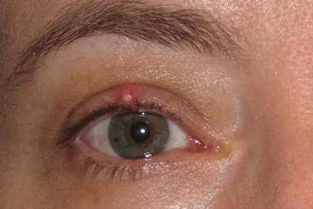 眼睛麥粒腫初期
