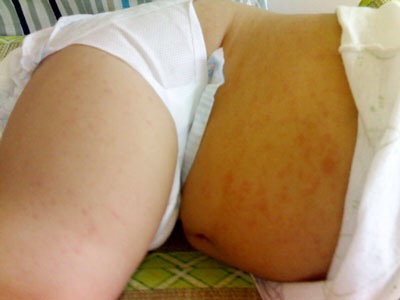 小兒急疹的症狀 (41) 