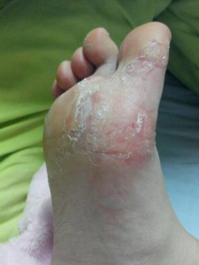 足蘚初期症狀