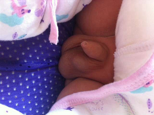 男寶寶疝氣的症狀