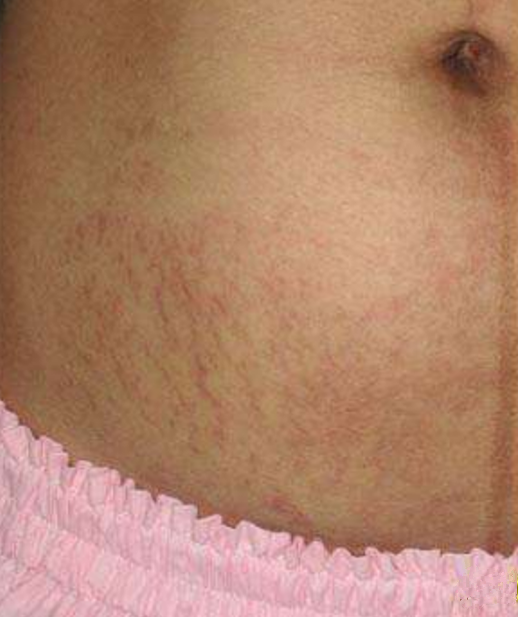 孕期女性的肚皮妊辰紋