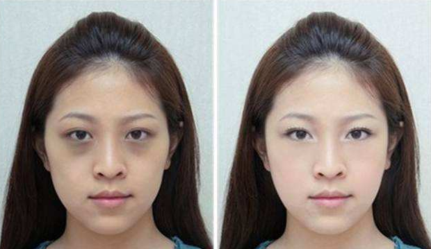 磨皮手術效果圖 (5) 