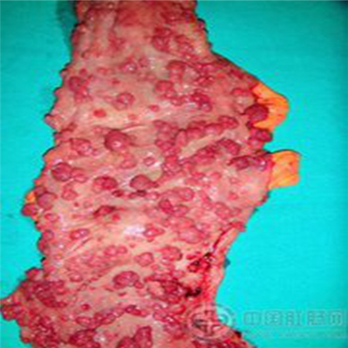 直腸息肉的細胞圖 