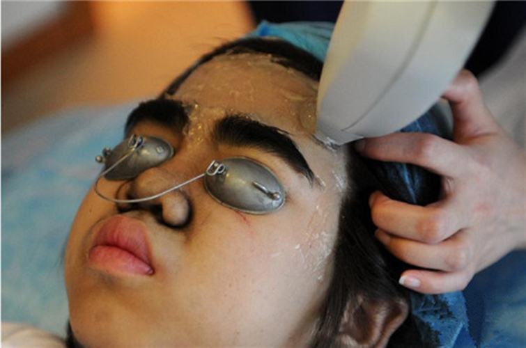 先天性全身多毛症治療