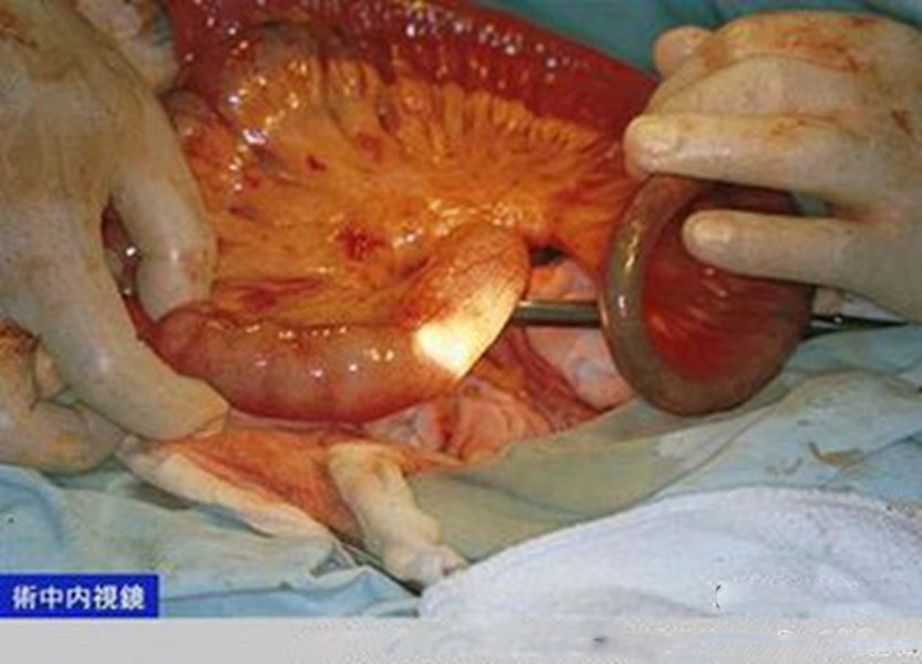 直腸腸腫瘤手術