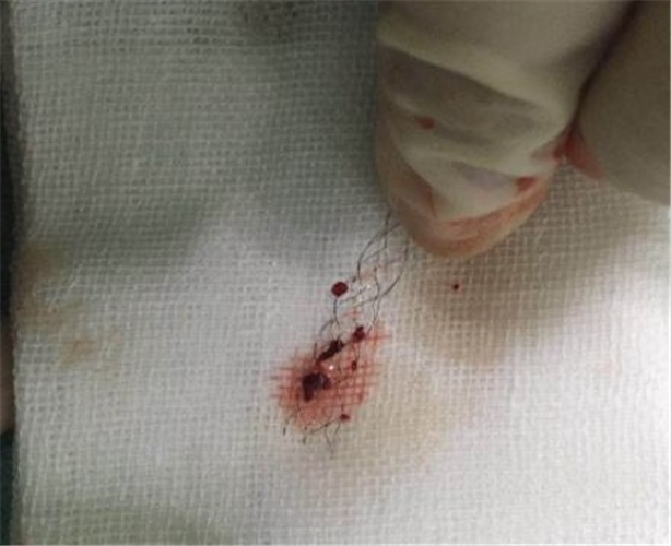 手術摘除的腦血栓