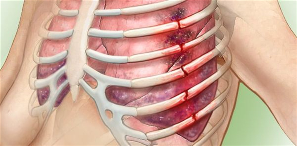 肋骨骨折危害