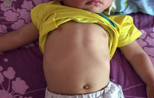 寶寶缺鈣雞胸圖 (55) 