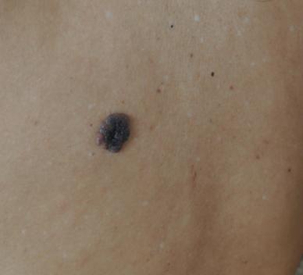 黑痣癌變