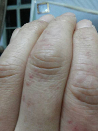 手指溼疹症狀